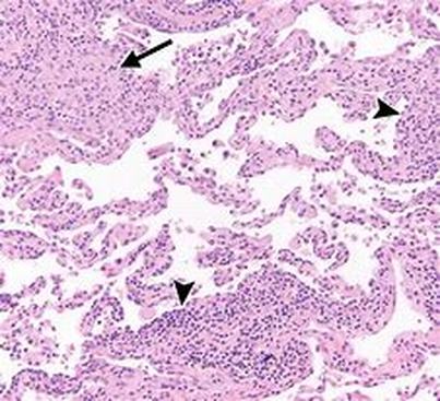 Hypersensitivity Pneumonitis CT Scan Image